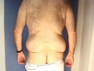 Body Lift Before & After Patient #2447