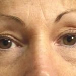 Eyelid Before & After Patient #2210