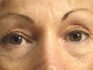 Eyelid Before & After Patient #2210