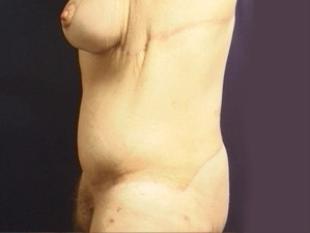 Body Lift Before & After Patient #2450