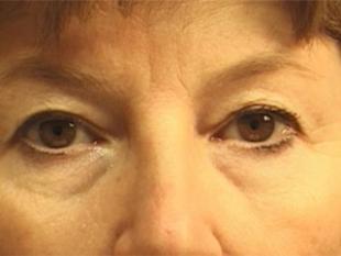 Eyelid Before & After Patient #2219
