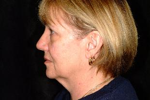 Facelift Before & After Patient #2191