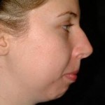 Rhinoplasty Before & After Patient #2222