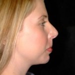Rhinoplasty Before & After Patient #2222