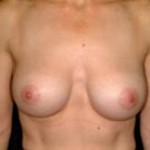 Breast Augmentation Before & After Patient #2229