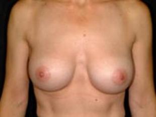 Breast Augmentation Before & After Patient #2229