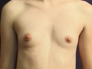 Breast Augmentation Before & After Patient #2234