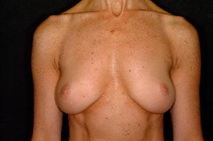 Breast Augmentation Before & After Patient #2244