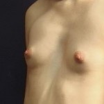 Breast Augmentation Before & After Patient #2249