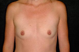 Breast Augmentation Before & After Patient #2252