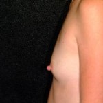 Breast Augmentation Before & After Patient #2257