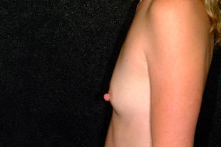 Breast Augmentation Before & After Patient #2257