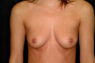 Breast Augmentation Before & After Patient #2260