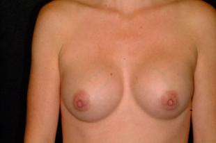 Breast Augmentation Before & After Patient #2260