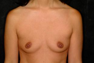Breast Augmentation Before & After Patient #2275