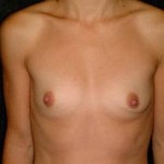 Breast Augmentation Before & After Patient #2294