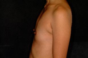 Breast Augmentation Before & After Patient #2306