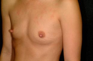 Breast Augmentation Before & After Patient #2311