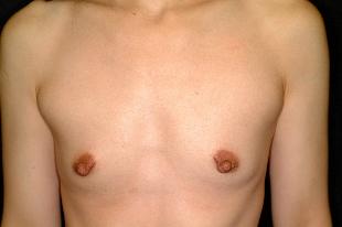 Breast Augmentation Before & After Patient #2321