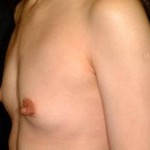 Breast Augmentation Before & After Patient #2321