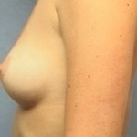 Breast Augmentation Before & After Patient #2331
