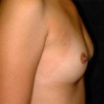 Breast Augmentation Before & After Patient #2339