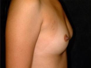 Breast Augmentation Before & After Patient #2339