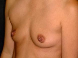 Breast Augmentation Before & After Patient #2342