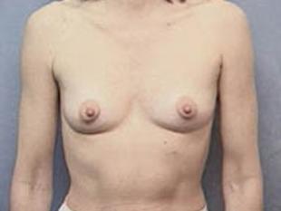 Breast Augmentation Before & After Patient #2345