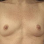 Breast Augmentation Before & After Patient #2348