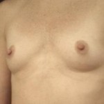 Breast Augmentation Before & After Patient #2348