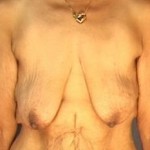 Breast Lift Before & After Patient #2356