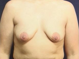 Breast Lift Before & After Patient #2362