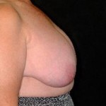Breast Reconstruction Before & After Patient #2374