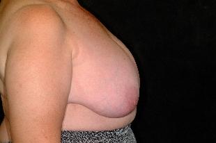 Breast Reconstruction Before & After Patient #2374