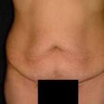 Abdominoplasty Before & After Patient #2384