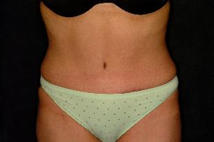 Abdominoplasty Before & After Patient #2384