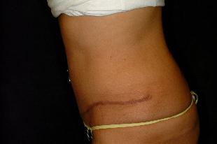 Abdominoplasty Before & After Patient #2390