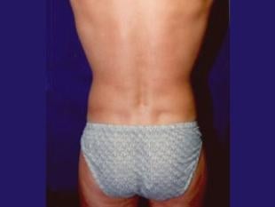 Male Liposuction Before & After Patient #2400