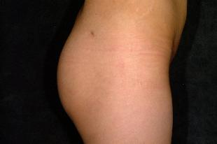 Butt Augmentation Before & After Patient #2403