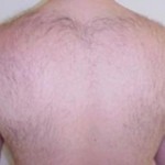 Laser Hair Removal Before & After Patient #2422