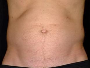 Ab Etching Before & After Patient #2428