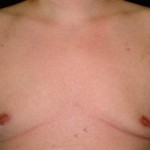 Male Breast Reduction (Gynecomastia) Before & After Patient #2436