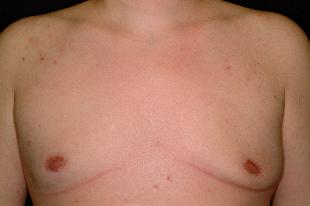 Male Breast Reduction (Gynecomastia) Before & After Patient #2436