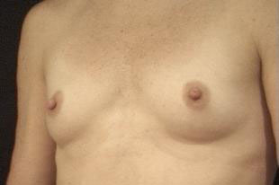 Breast Augmentation Before & After Patient #2280
