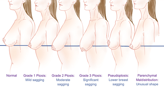 Saggy Breasts? What are the Causes-Understanding Breast Lift & What Can be  Achieved?