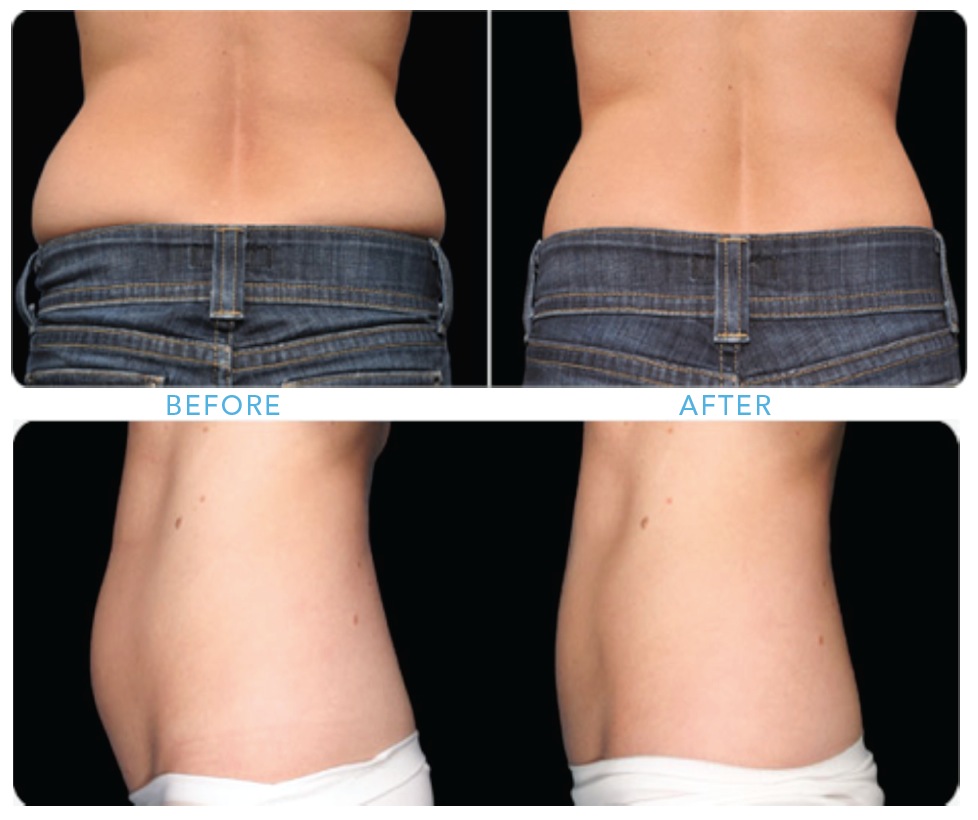 Busy Mom, But CoolSculpting Got My Body Back!! - Korman Plastic Surgery