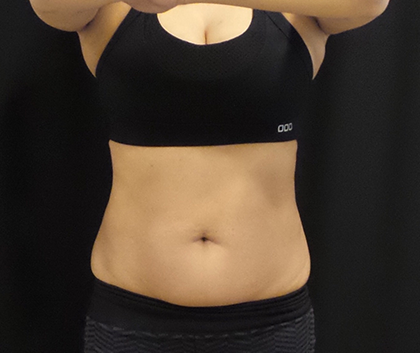 CoolSculpting Before & After Patient #4993