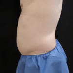 CoolSculpting Before & After Patient #4968