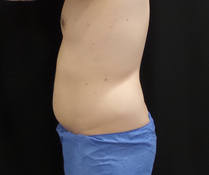 CoolSculpting Before & After Patient #4983